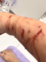 Tutora tem braço dilacerado após ataque de gato