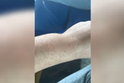 Homem mostra o braço inchado por causa das algemas