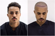 Livinho implantou 1,4 mil fios de cabelo