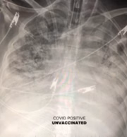 Pulmão de pessoa que não recebeu a vacina e foi contaminada
