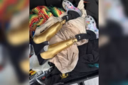 Conhecida como "a garota com pernas de ouro" devido às suas próteses douradas