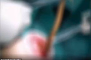 Os médicos retiraram o peixe