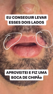"Deixa eu desabafar com vocês, eu fiz esse procedimento de mudar porque eu não aguentava mais ser chamado de feio no direct, e isso mexe comigo", disse