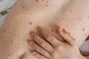 A doença pode se manifestar a qualquer momento em pessoas que já tiveram catapora ou a própria herpes-zóster alguma vez na vida. O vírus permanece inativo no corpo por muitos anos, podendo ser reativado na forma mais localizada em um nervo 
