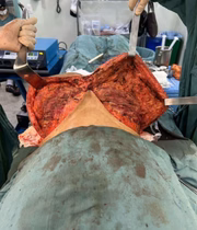 Vicki Demito passa por cirurgia para retirar silicone industrial 