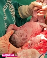 Mãe dá luz a quadrigêmeos