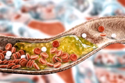 Dentre as doenças cardiovasculares que mais fazem vítimas fatais, o Acidente Vascular Cerebral (AVC) se destaca. Ele é causado devido à presença de placas de gordura que entopem os vasos sanguíneos cerebrais. Entre os sintomas estão: dificuldade para falar, tontura, dificuldade para engolir, fraqueza de um lado do corpo, entre outros