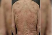 No dia 21, quando já tinha 95% do corpo curado