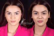 Eslovênia Marques passou por uma harmonização facial 