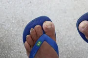 Pés e unhas de usuária sem cuidados