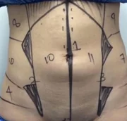 Imagem da marcação feita por Wilian em uma paciente antes da cirurgia