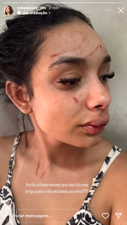 Milena Victoria de Souza mostrou o resultado de sua briga com Bia Miranda