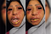 Mulher chegou a chorar secreção e vomitou devido à reação alérgica