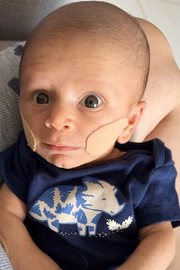 O bebê também usou bandagens para fortalecer a musculatura do rosto