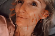 Sarah Bradden é especialista em acupuntura facial