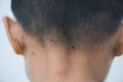 Entre os sintomas da condição estão: febre, dor de cabeça, dor no corpo e nas costas, inchaço nos linfonodos, exaustão e calafrios. Também há bolinhas que aparecem no corpo inteiro (principalmente rosto, mãos e pés) e evoluem, formando crostas, que mais tarde caem