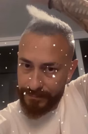 Fred mostrou o estado precário do cabelo nas redes sociais