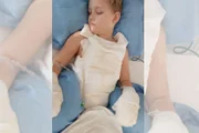 Ela teve queimaduras na barriga