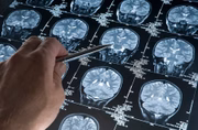 Estima-se que 78 milhões de pessoas sejam diagnosticadas com demência até 2030