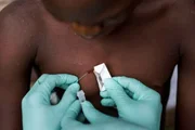 O período de incubação do vírus varia de sete a 21 dias, mas os sintomas, que podem ser muito pruriginosos ou dolorosos, geralmente aparecem após 10 dias
