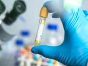A hepatite A é causada por um vírus que pode ser transmitido pelo ato sexual ou pelo consumo de água e alimentos contaminados. O diagnóstico é feito por meio de exames clínicos e laboratoriais 
