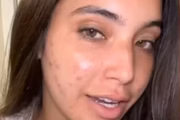 Vanessa Lopes mostra rosto com acnes e desabafa sobre saúde mental