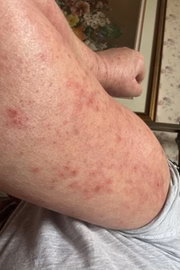 A escocesa desenvolveu erupções cutâneas por todo o corpo