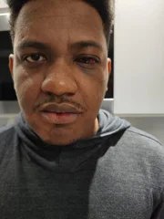 Rosto de Bruno neste domingo (31), mais de 24 horas após a agressão