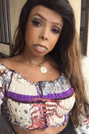 Ela tem uma doença autoimune
