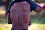 Marcas do cassetete: lesão na clavícula