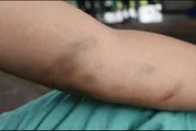 Marcas roxas em paciente 