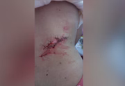 A jovem recebeu 28 pontos nas costas após se machucar em casa