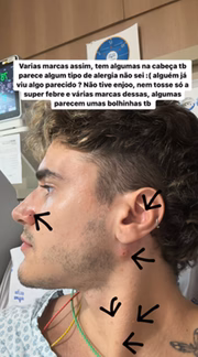 Alex Mapeli mostra machucados na pele