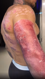 Um botijão de gás explodiu e queimou mais de 30% do corpo do cantor