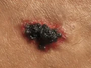 O melanoma, por sua vez, tem menos casos registrados e é mais grave, devido à possibilidade de se espalhar para outras partes do corpo. Por isso é importante fazer visitas periódicas ao dermatologista e questionar sobre sinais suspeitos
