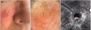 Menor melanoma do mundo é identificado, tem 0,65mm, menos que um fio de cabelo