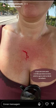 Natasha mostrou os ferimentos nos Stories