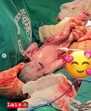 Mãe dá luz a quadrigêmeos