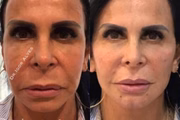 Antes de depois de Gretchen 