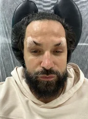 O artista fez intervenções estéticas no rosto e apareceu com a face bastante inchada